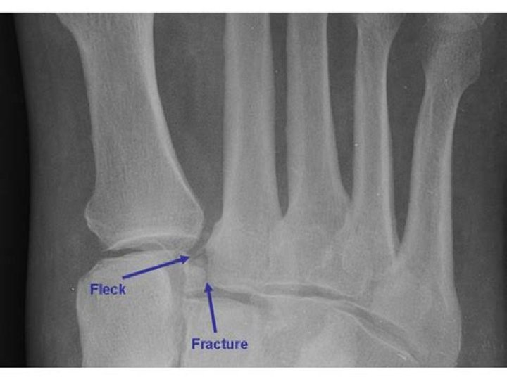 Whats a fleck fracture?