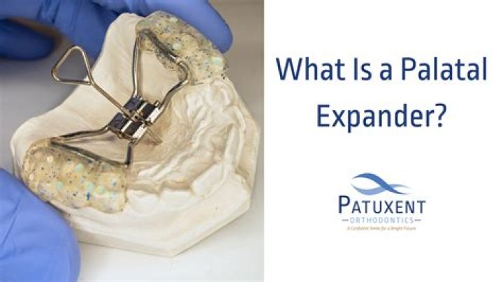 Whats a palate expander?