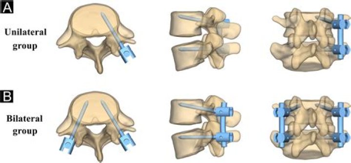 Whats a tube pedicle?