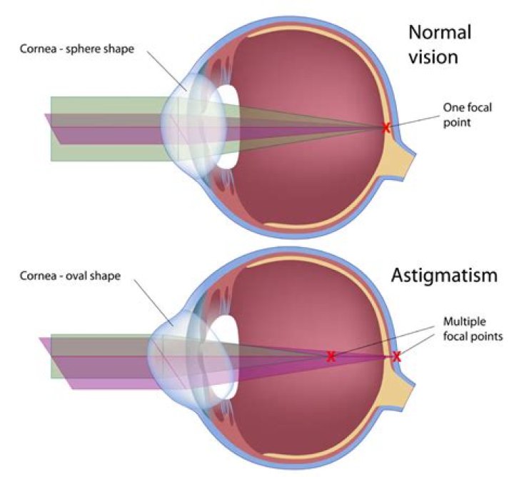 Whats astigmatism in eyes?