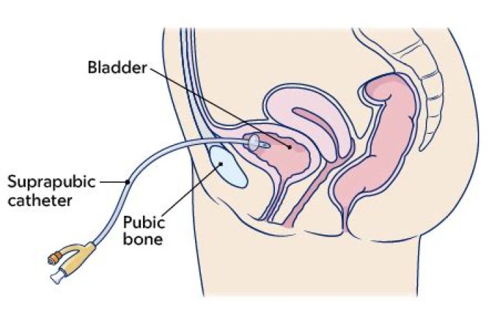 When catheter is not draining?