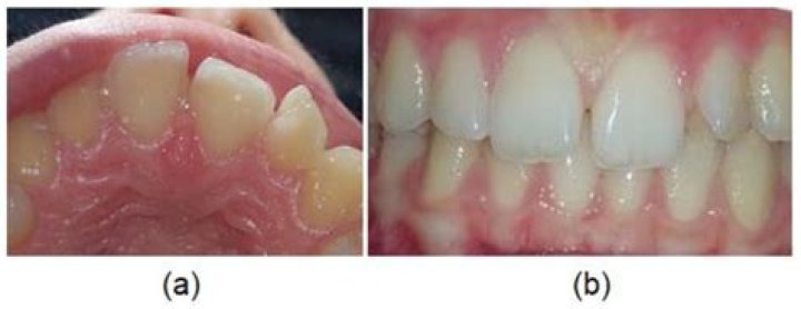 When do incisors grow back?