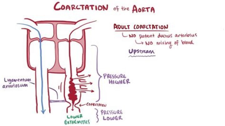 When does coarctation occur?