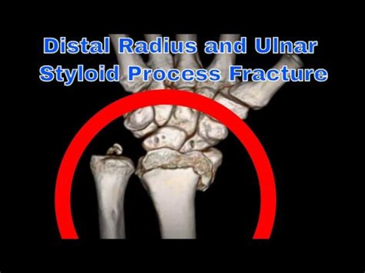 When does ulnar styloid fuse?