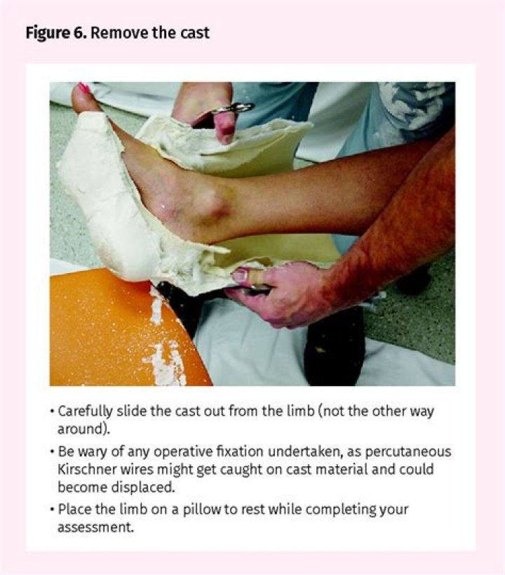 When plaster cast is removed?