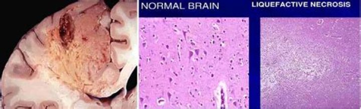 Where can liquefactive necrosis be found?