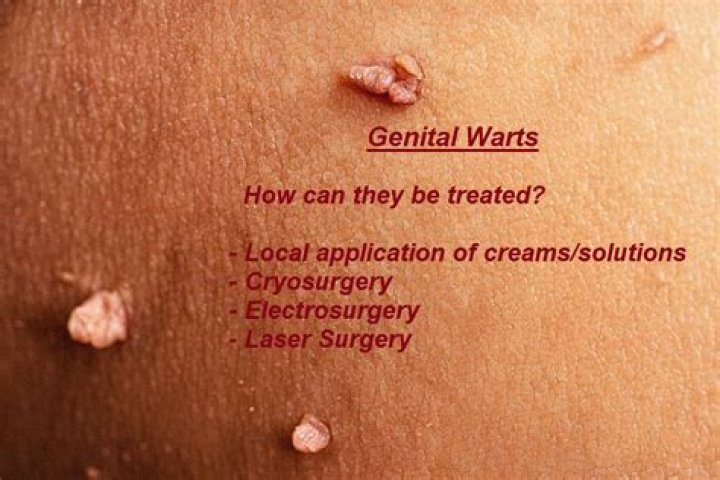 Where do genital warts appear on males?