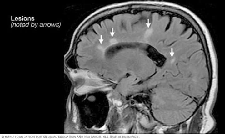 Where do lesions appear in ms?