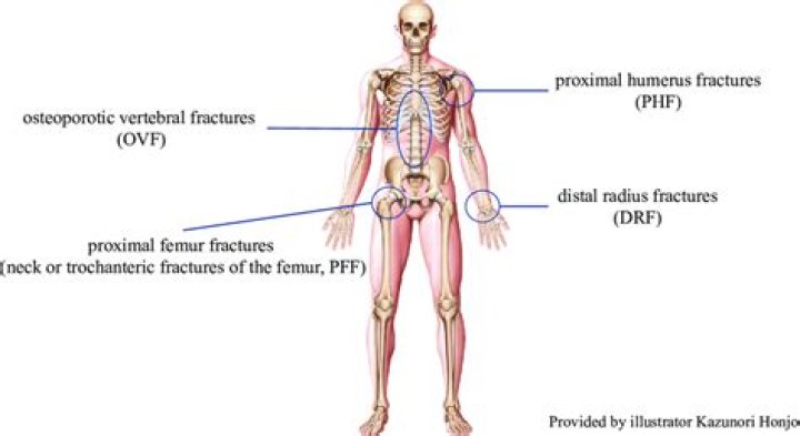 Where do most osteoporotic fractures occur?