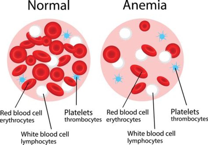 Where does anemia come from?