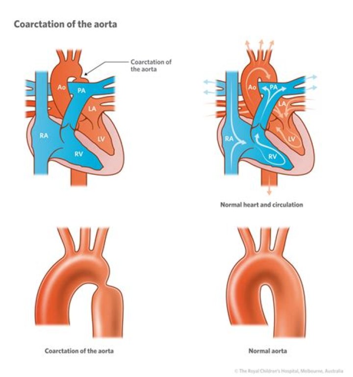 Which assessment indicates a coarctation of the aorta?