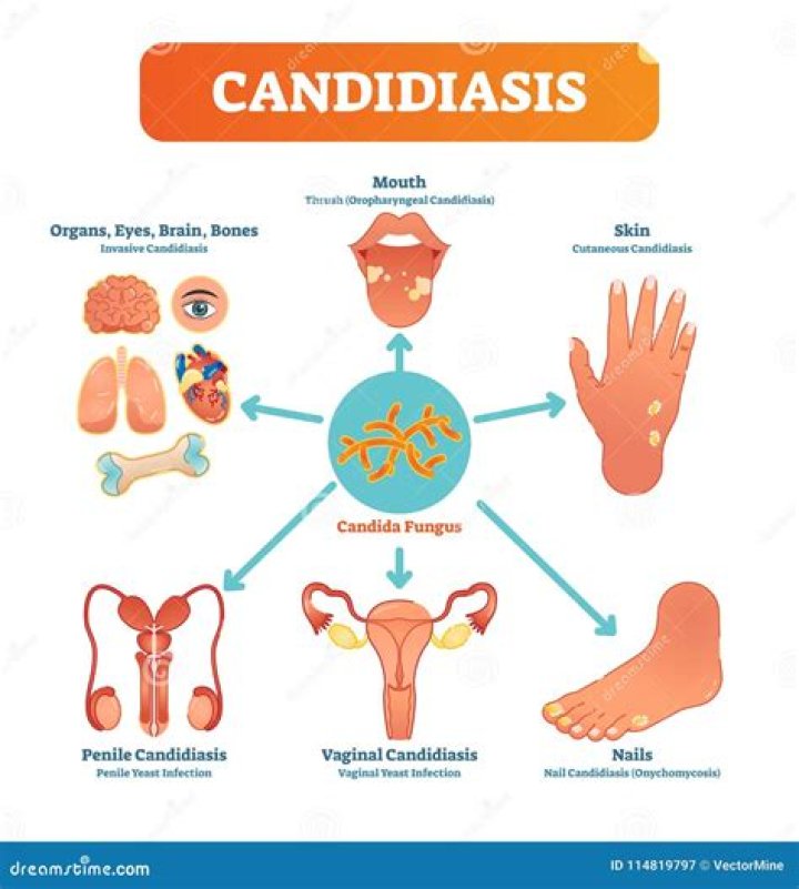 Which form of candidiasis is also known as erythematous?