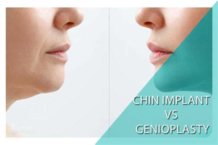 Which is better chin implant or genioplasty?