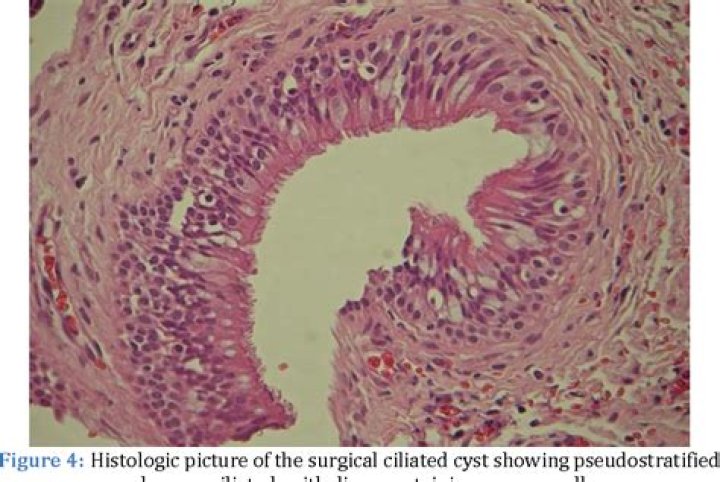 Which of the following is characteristic of an antral pseudocyst?