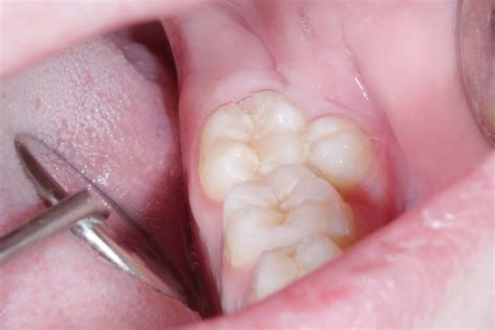 Which percentage of natal teeth are supernumerary?