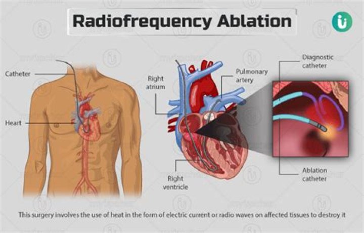 Who performs radiofrequency ablation?
