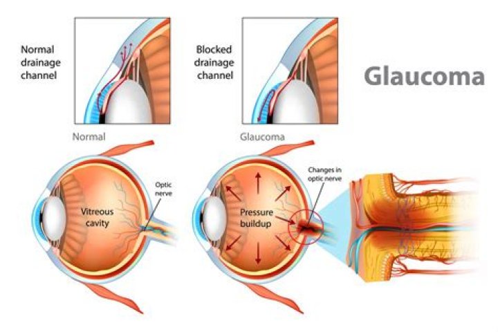 Whos at risk for glaucoma?