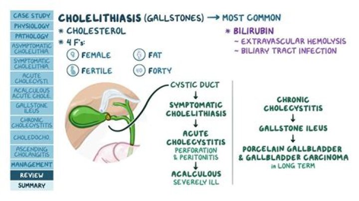 Why cholelithiasis is more common in females?