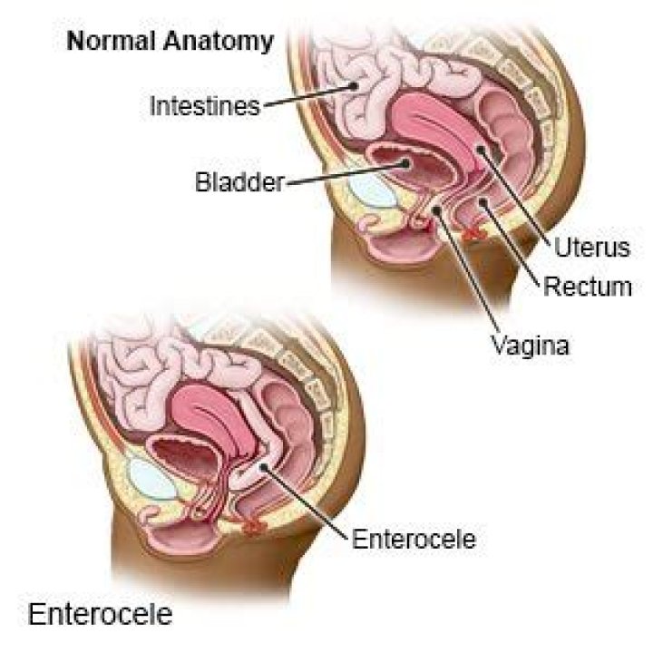 Why do you get enterocele?