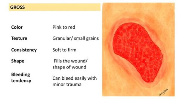 Why does granulation tissue hurt?