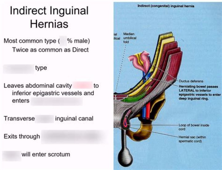 Why is an indirect inguinal hernia?