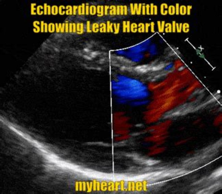 Will an echocardiogram show blockages in the heart?