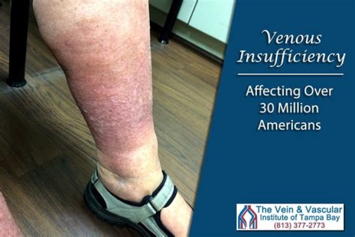 Will exercise help venous insufficiency?