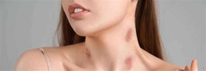 Will hickeys kill you?