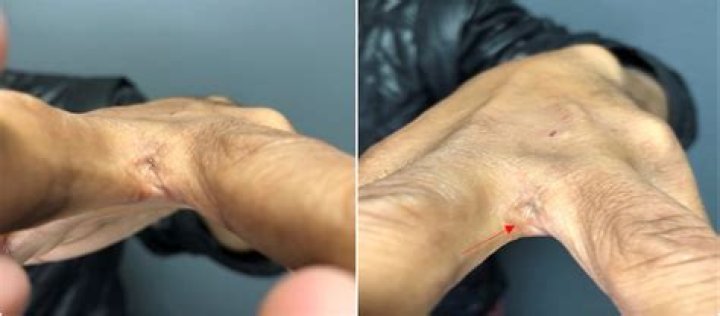 Will interdigital cyst go away on its own?