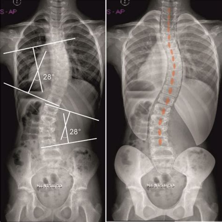 Will scoliosis disqualify you from military?