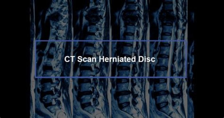 Would a ct scan show a herniated disc?