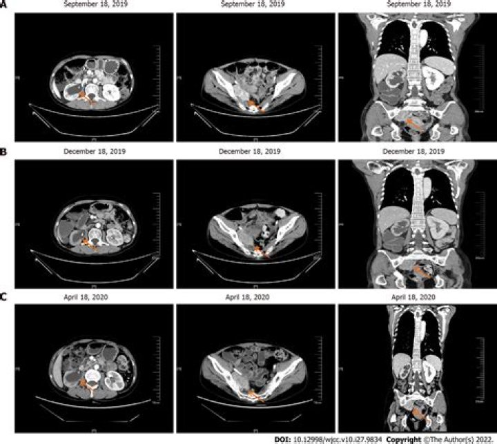 Would worms show up on a ct scan?