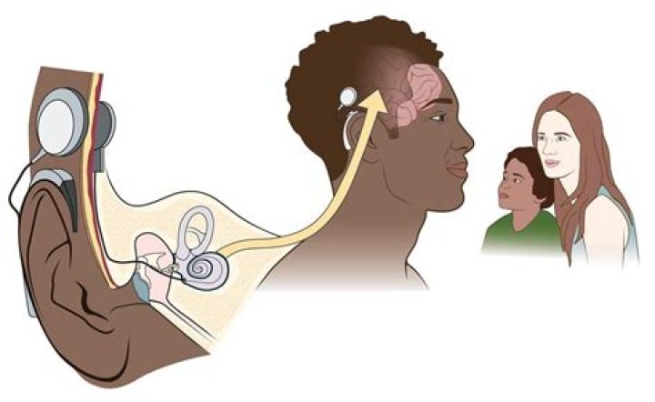 Would you elect to get a cochlear implant?